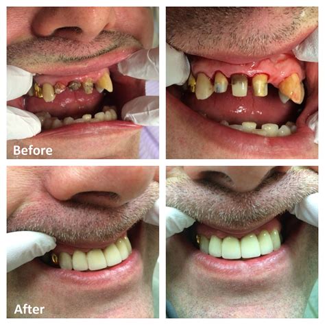 getting metal pre fabricated crown|dental crowns before and after.